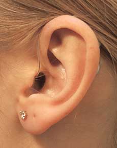 Receiver-in-the-ear (RITE)